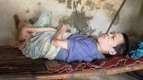 Người con trai bị bệnh bại não từ nhỏ!